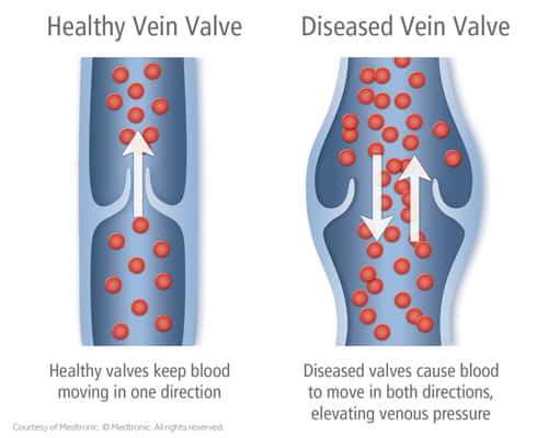 Healthy vs. diseased vein