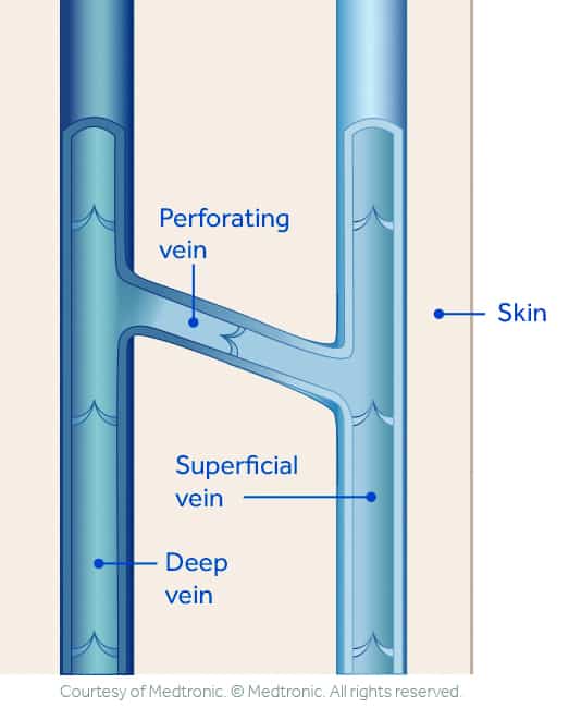 Superficial deep perforator veins illustration