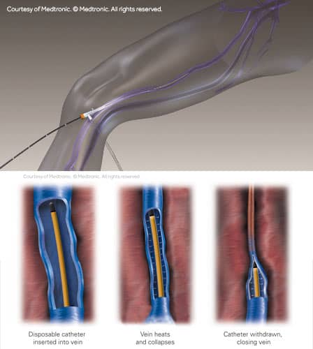 radiofrequency ablation illustration