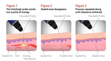 Illustrations of VeinGogh procedure