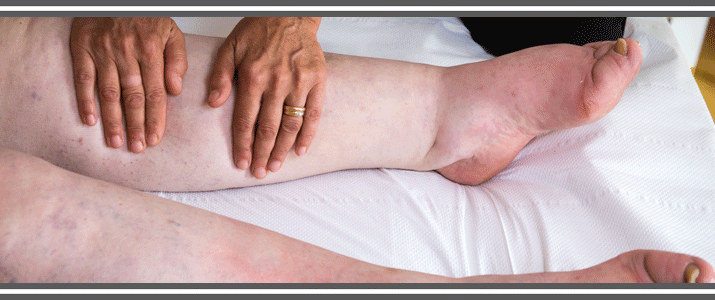 Women getting treated for lymphedema on her legs.