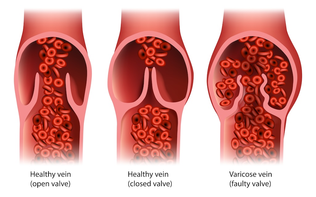 How faulty valves cause varicose veins