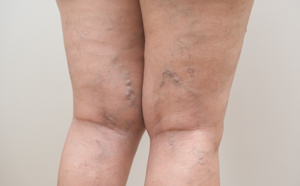 Varicose veins on the back of the legs.