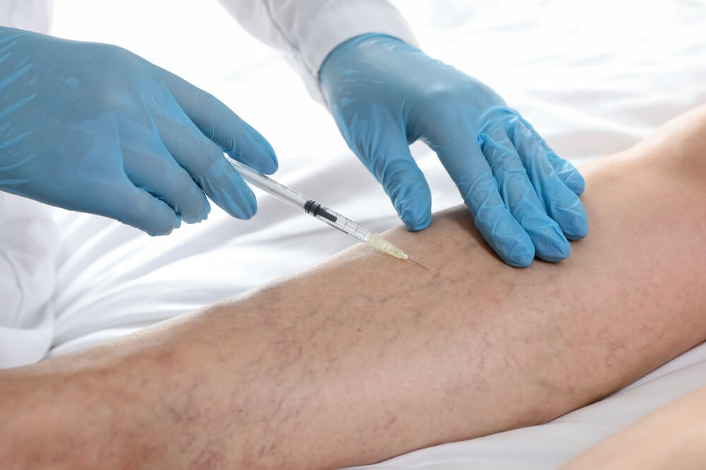 A doctor treating varicose veins with an injection on a leg.