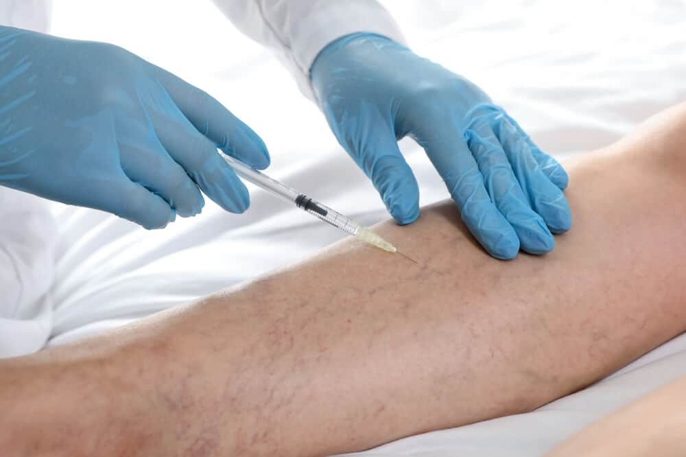 1739909531 doctor treating varicose veins 1