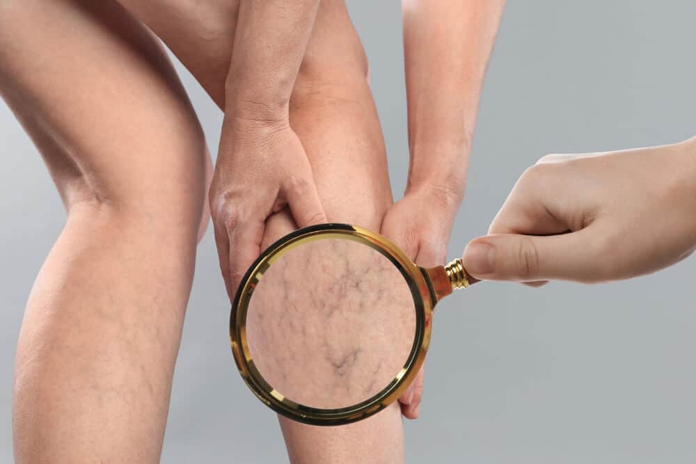 1739909621 woman with varicose veins