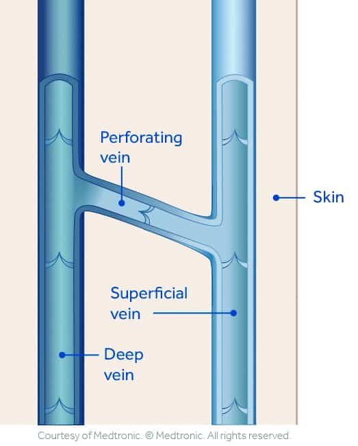 1739909635 Superficial Deep Perforator Veins Illustration