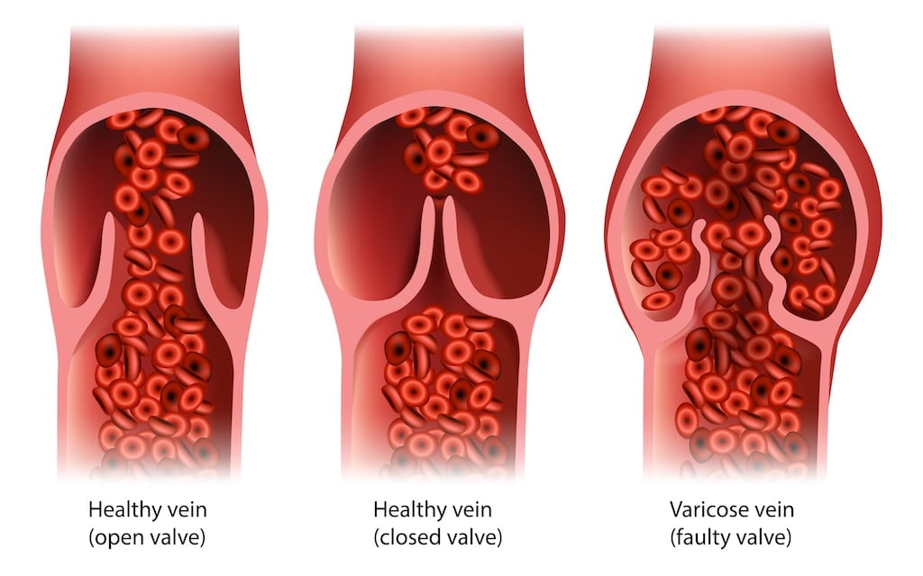 varicose veins faulty valve