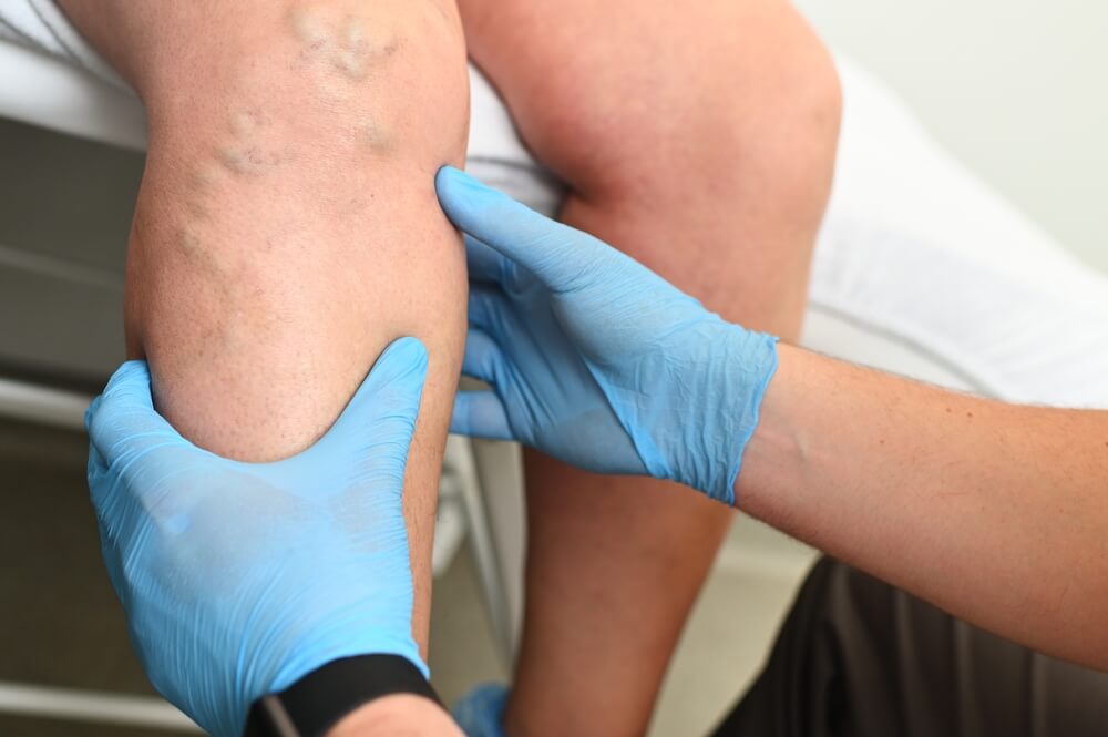 vein treatment on woman