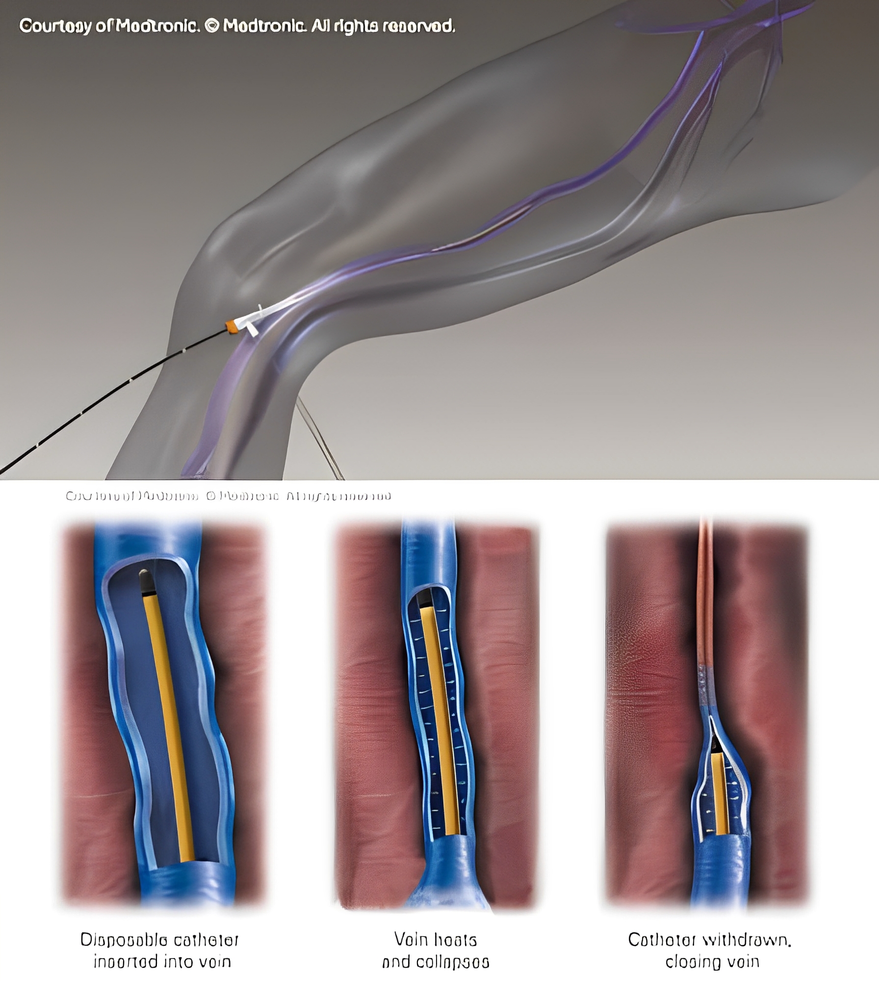 1739909649 rf treatment 1