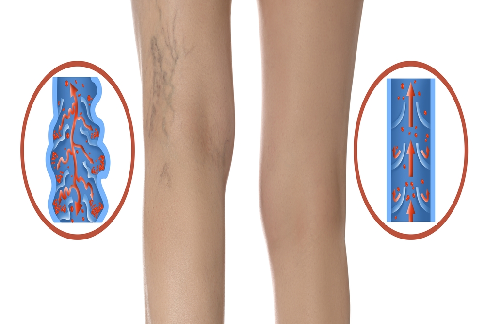Close-up of a woman's legs showing visible varicose veins, highlighting signs of venous insufficiency and leg vein health concerns