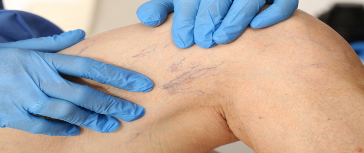Spider,Veins,On,Leg