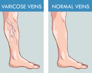 Side by side drawings of normal and varicose veins