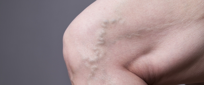 Vein Disease
