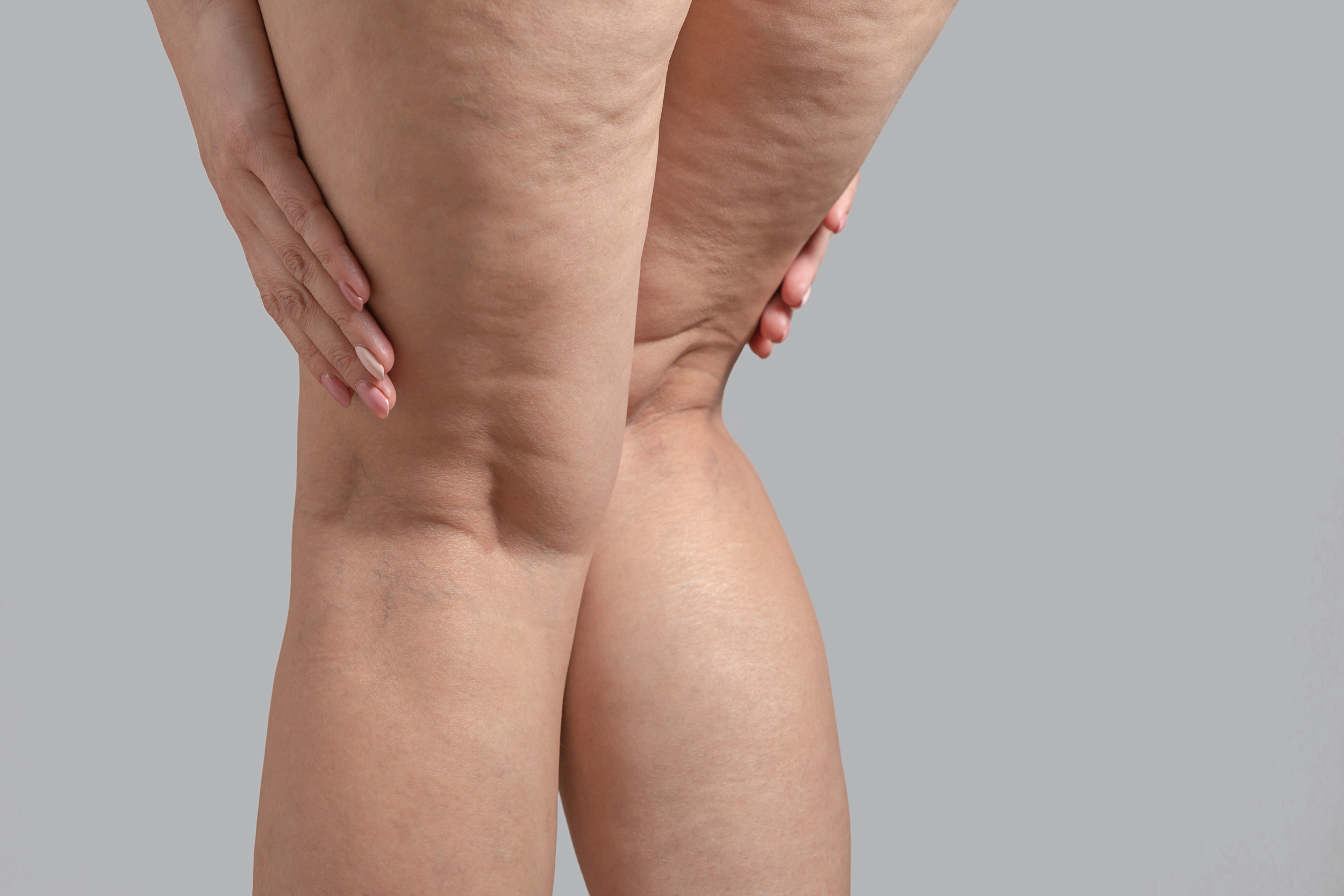Woman with varicose veins clutches her legs in embarrassment before endovenous ablation