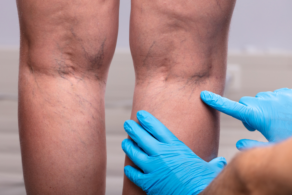 Doctor points to varicose veins on the back of a woman's legs