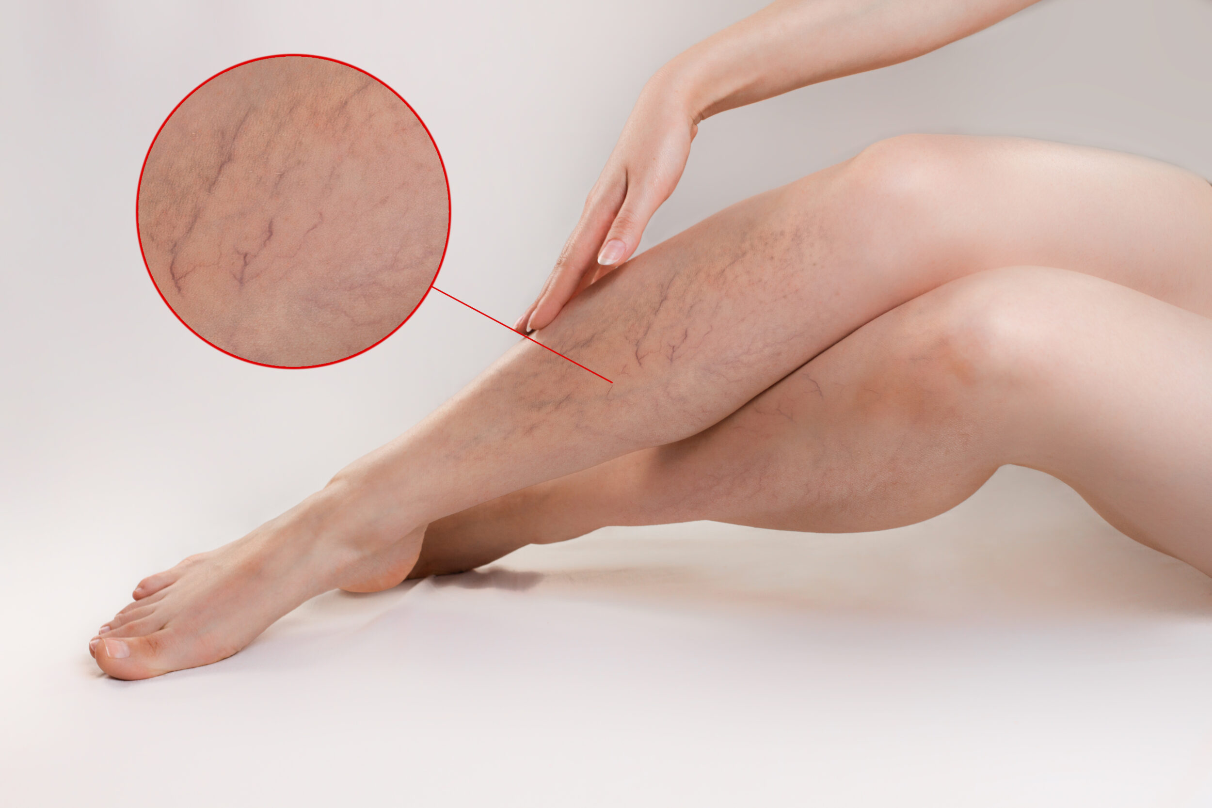 Woman sits on the floor and crosses one leg over the other, revealing signs of vein disease