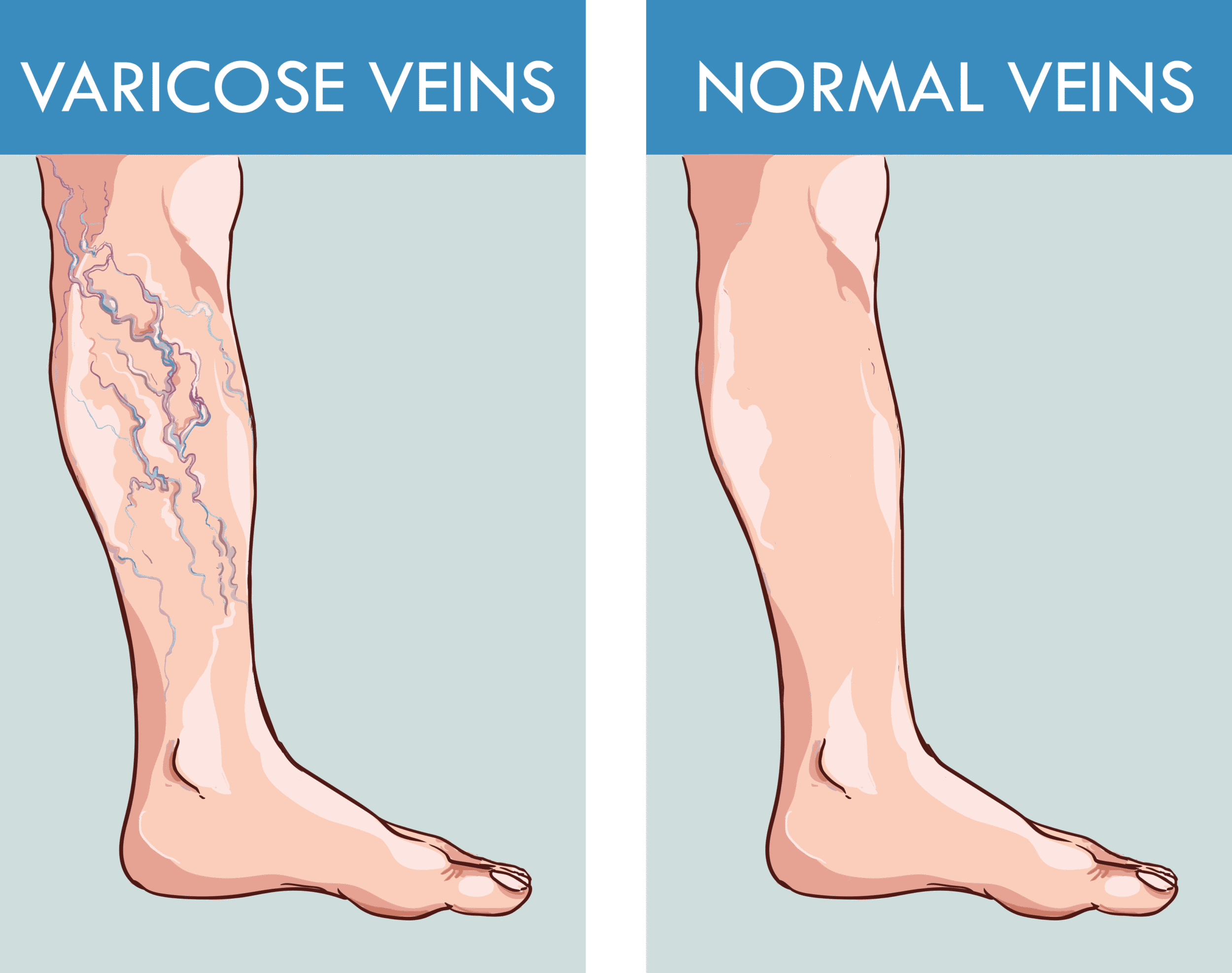 Artist's depiction of normal veins versus varicose veins in a leg