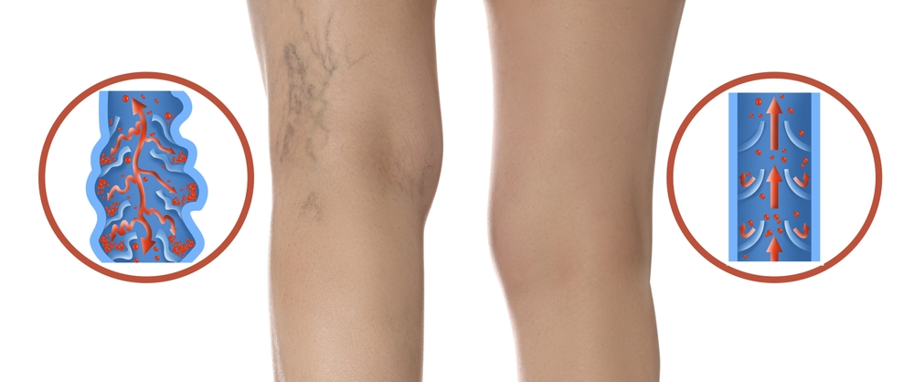 Image depicting healthy veins compared to varicose veins in a woman with chronic venous insufficiency in Austin