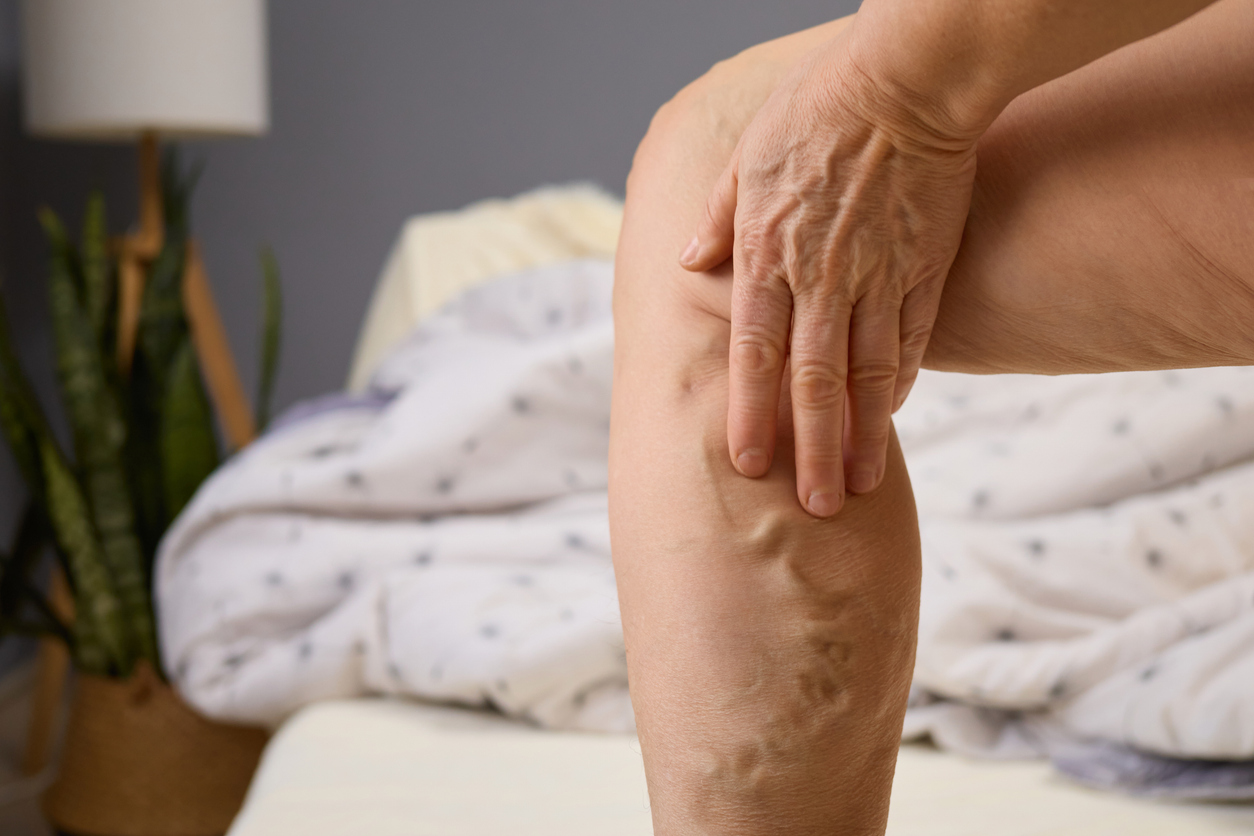 Close-up shot of varicose veins before ambulatory microphlebectomy in Austin