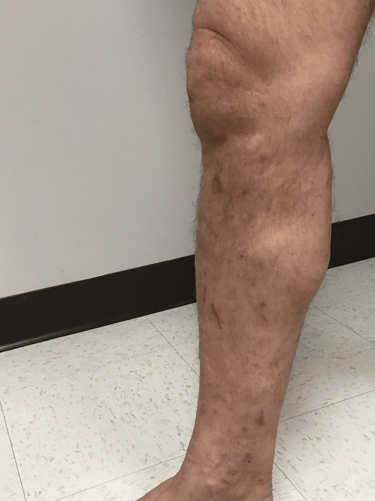 Leg after vein treatment