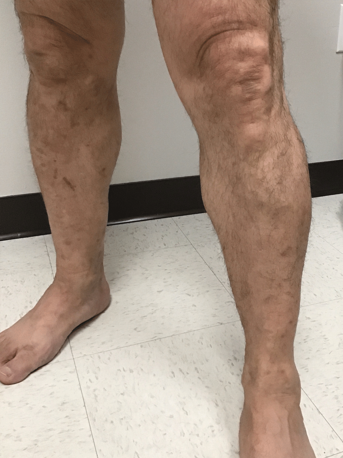 Legs after vein treatment
