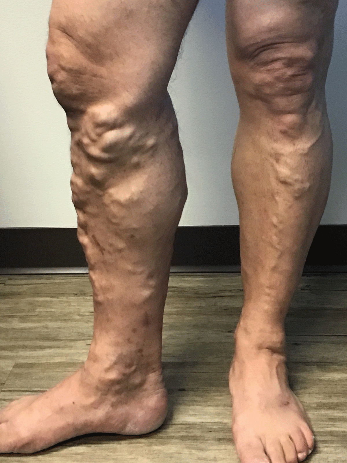 Legs before vein treatment